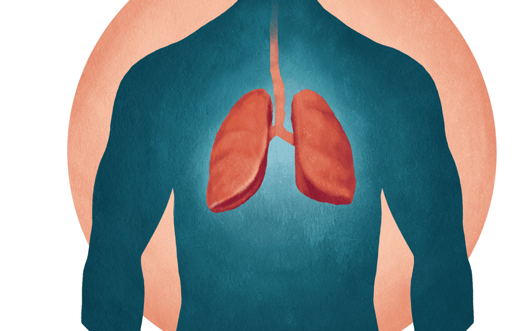 Teikning sem sýnir staðsetningu lungnakrabbameins